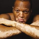 Psychological aspects of dealing with Vitiligo