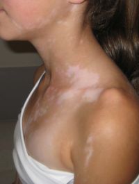 segmental-vitiligo-small
