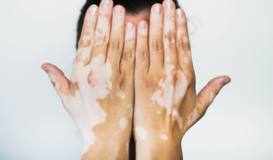 vitiligo treatment information