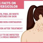 What Is The Difference Between Tinea Versicolor And Vitiligo