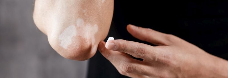 Ruxolitinib cream vitiligo